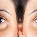 How to Get Rid of Eyebags Naturally Without Surgery?